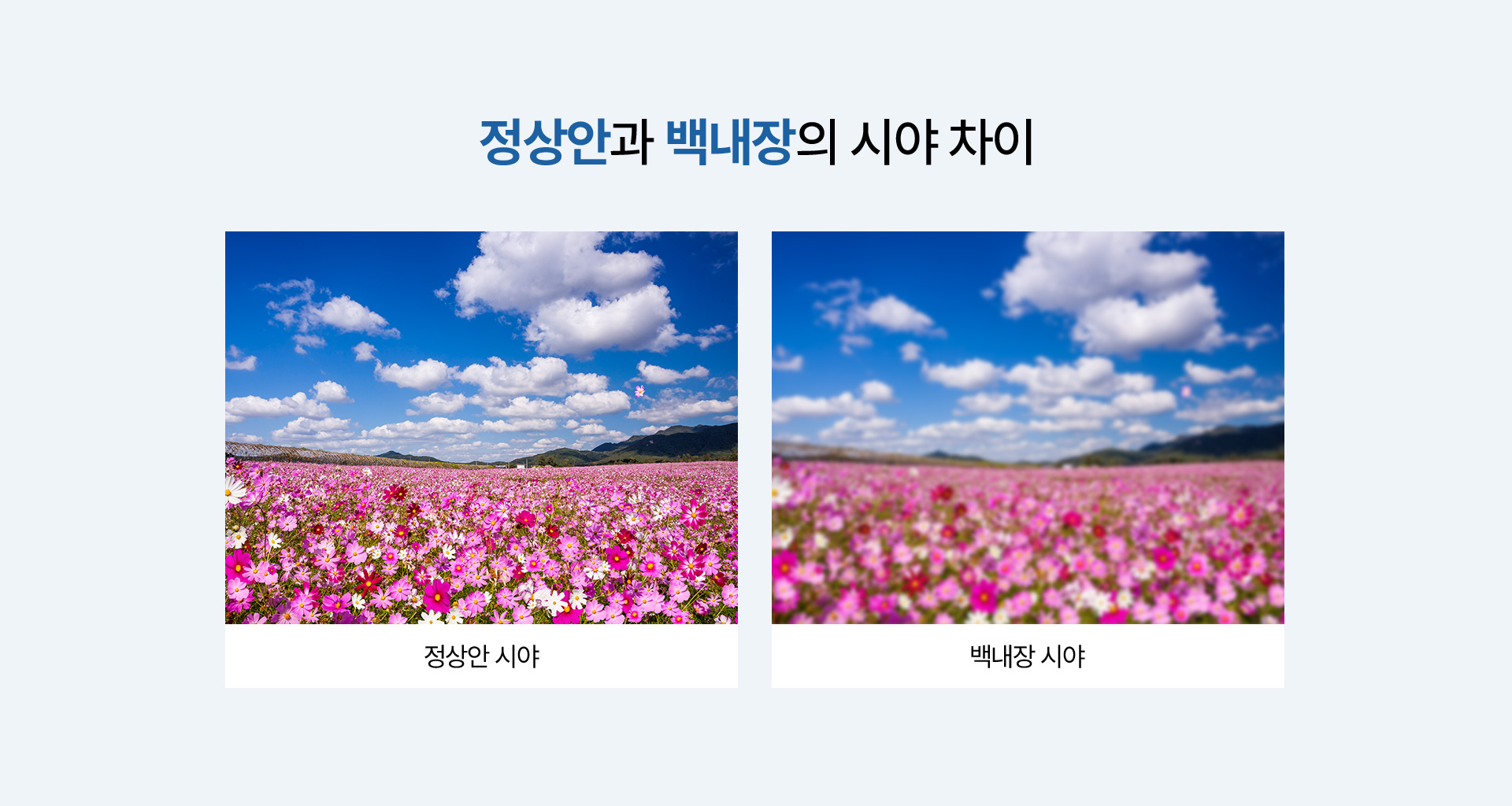 백내장_03