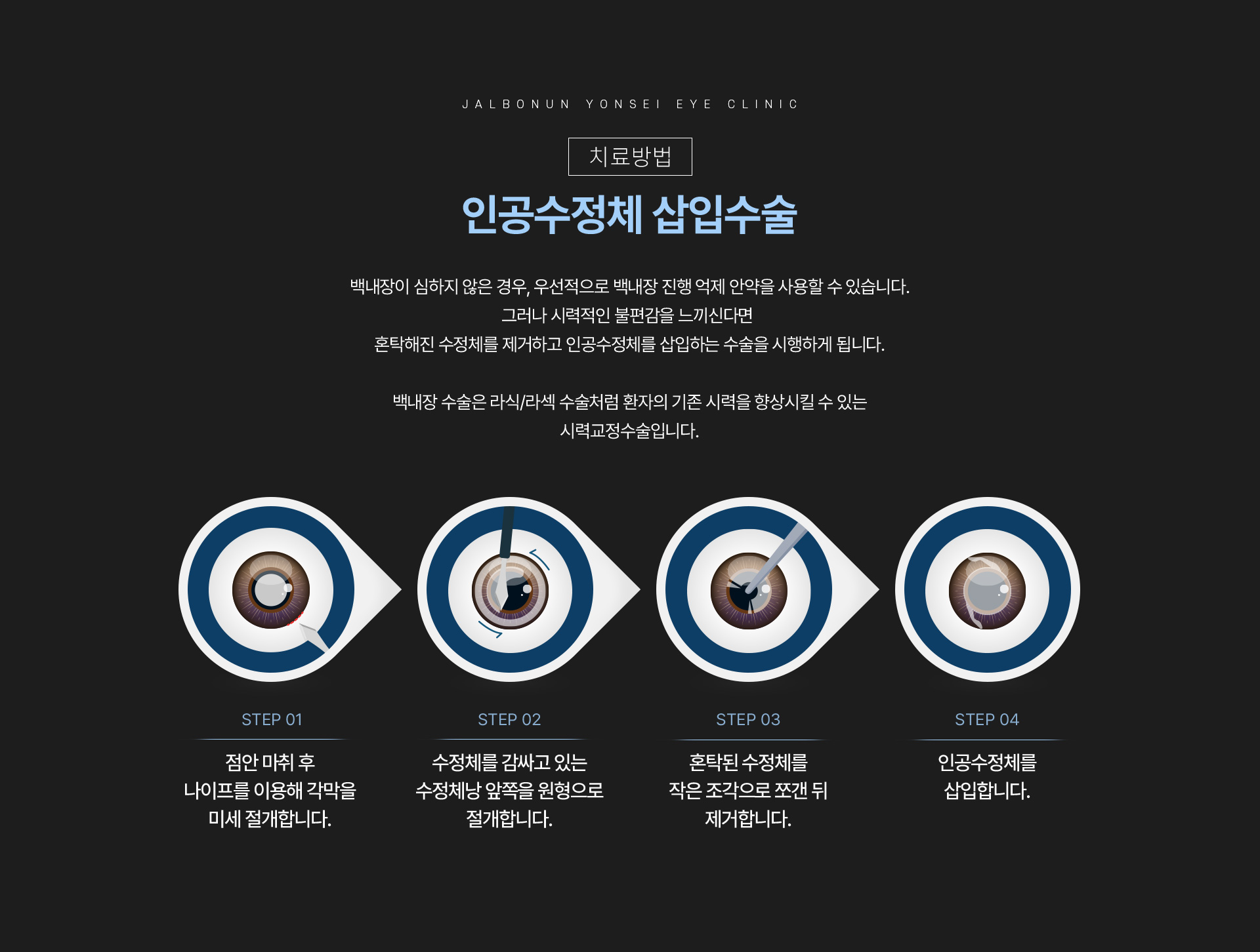 백내장_07