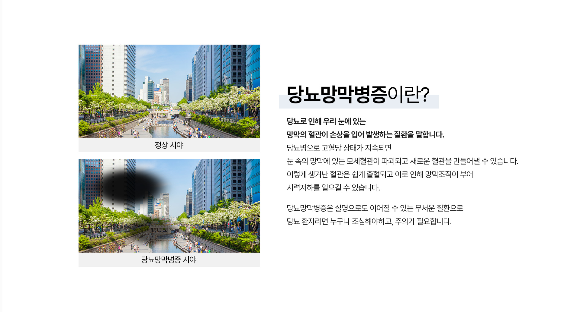 당뇨망막병증_01