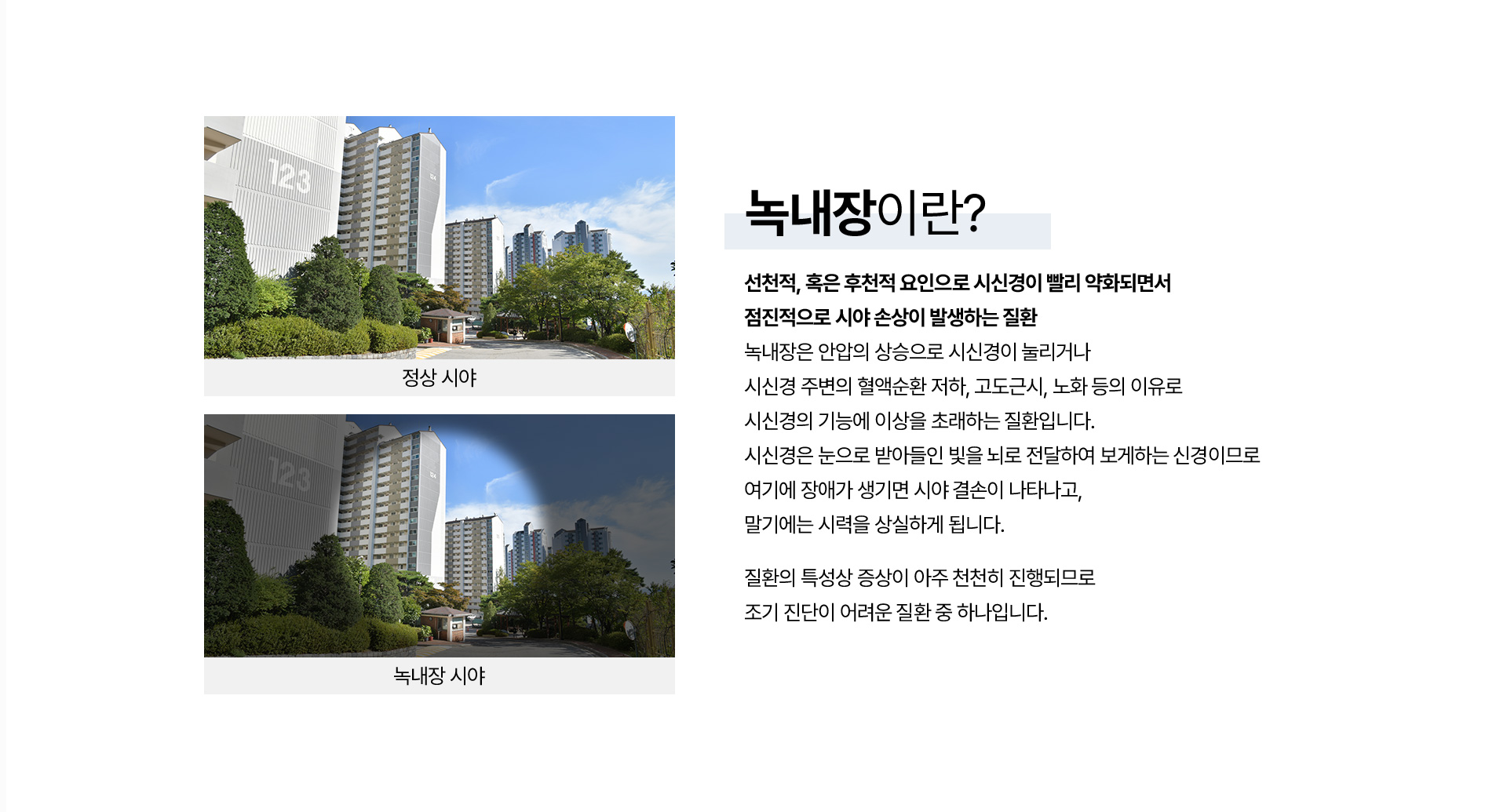 녹내장_01