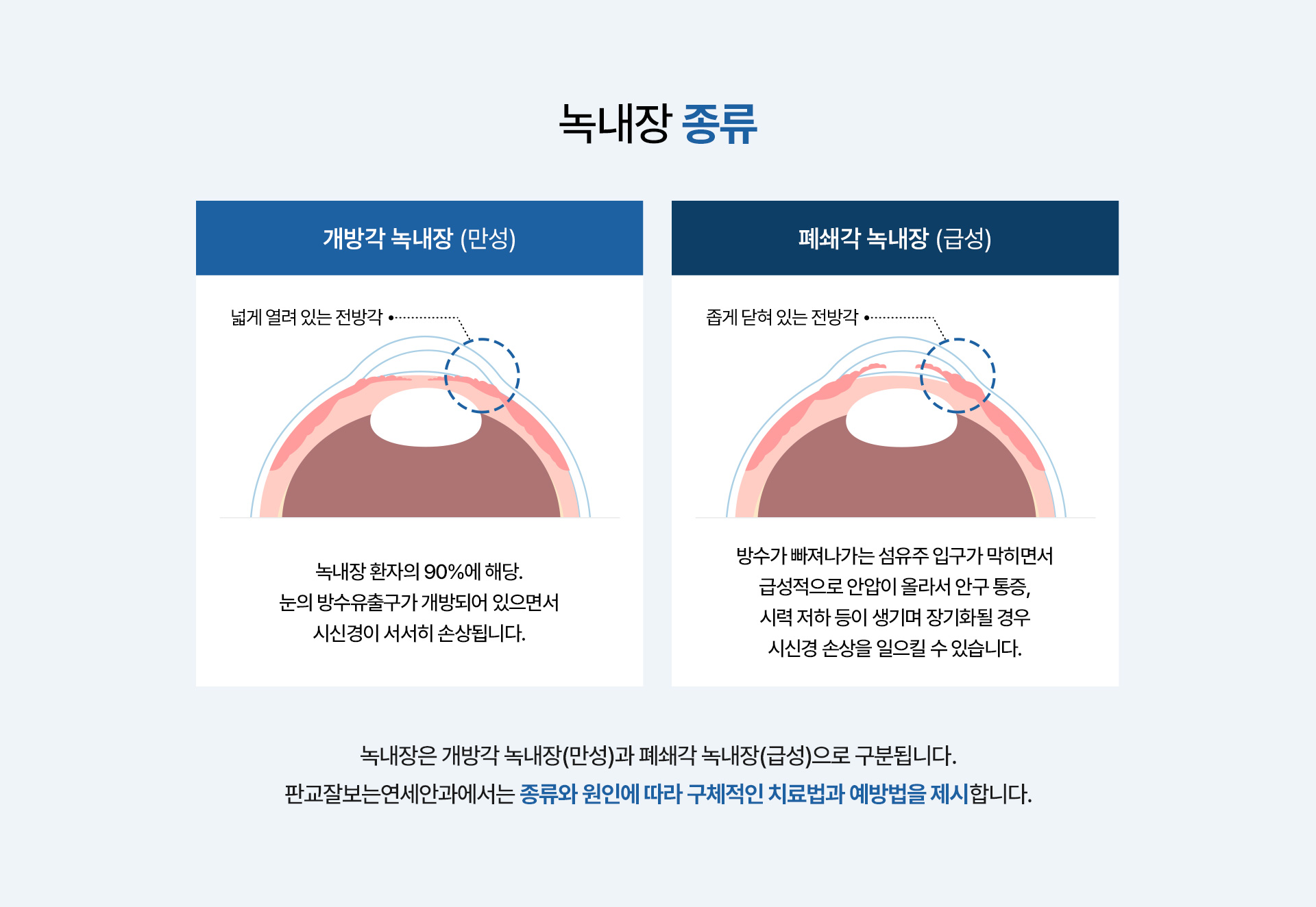 녹내장_02