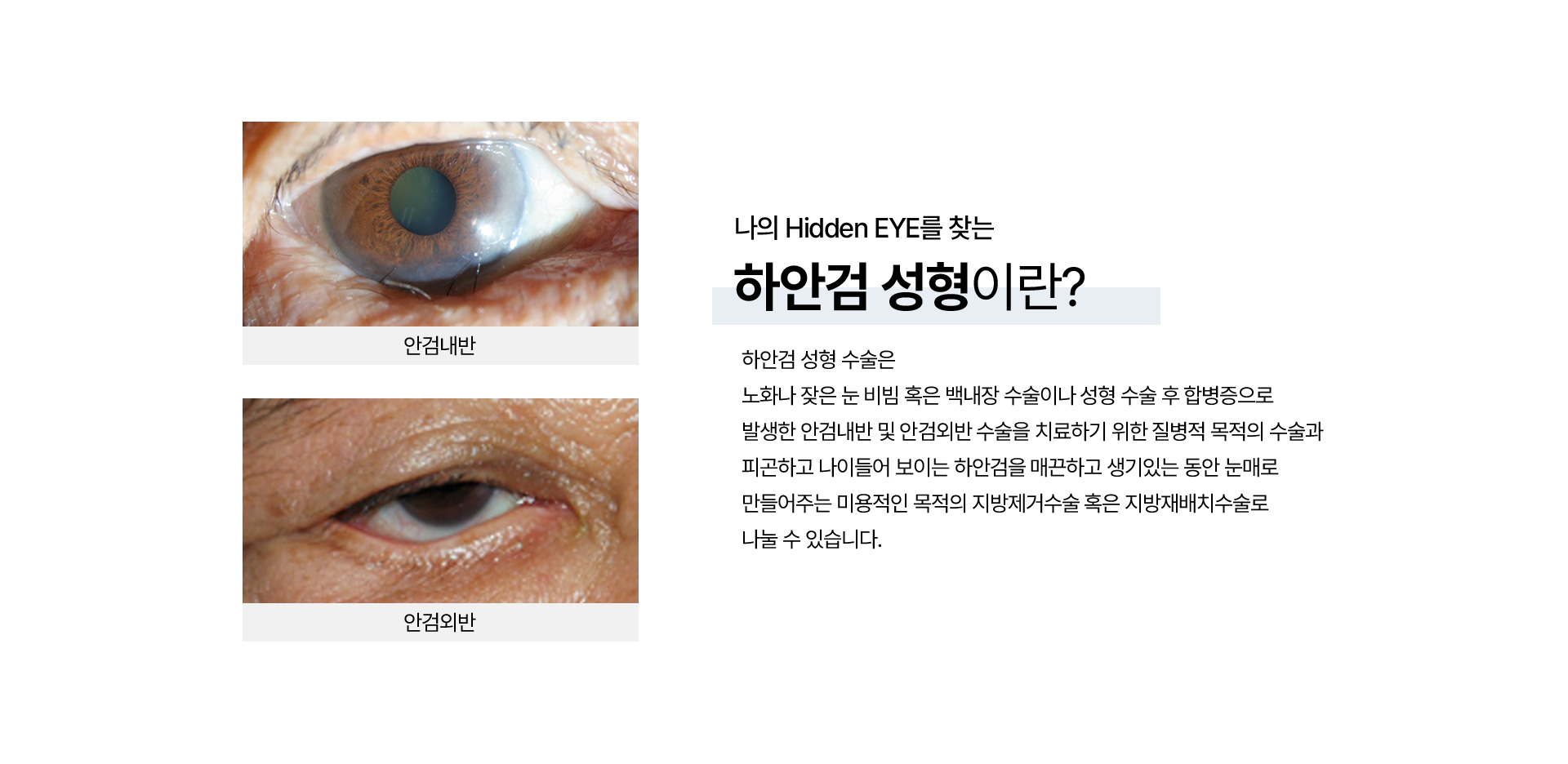 하안검 성형_05
