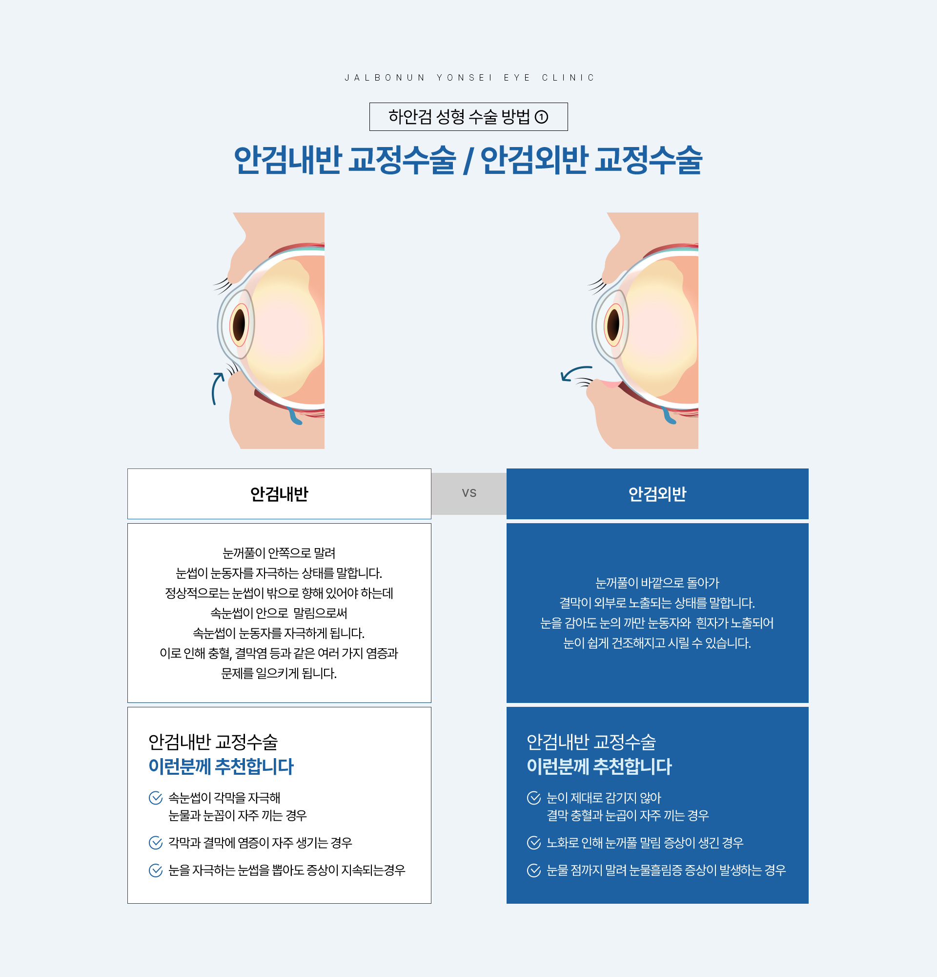 하안검 성형_07