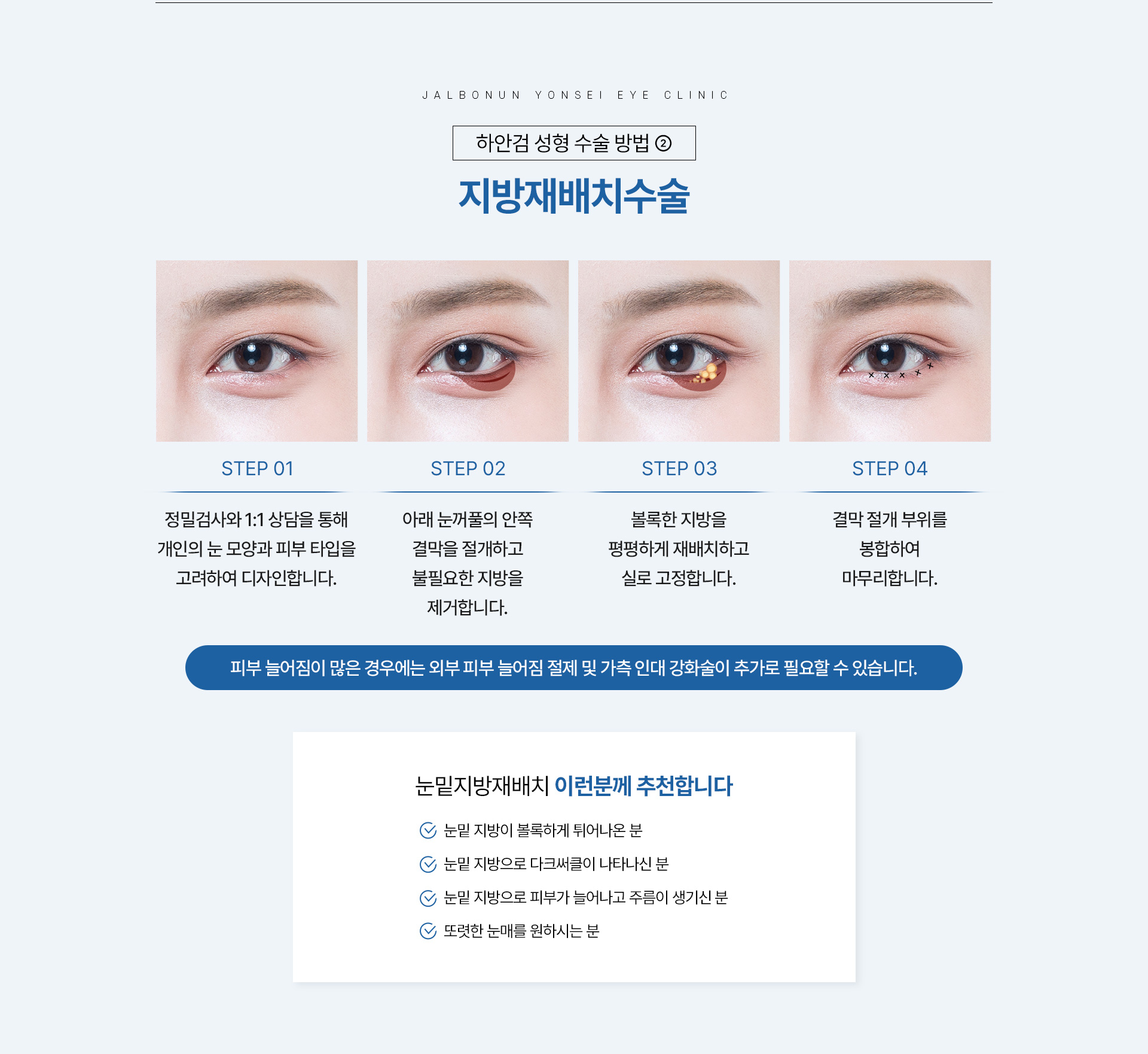 하안검 성형_08
