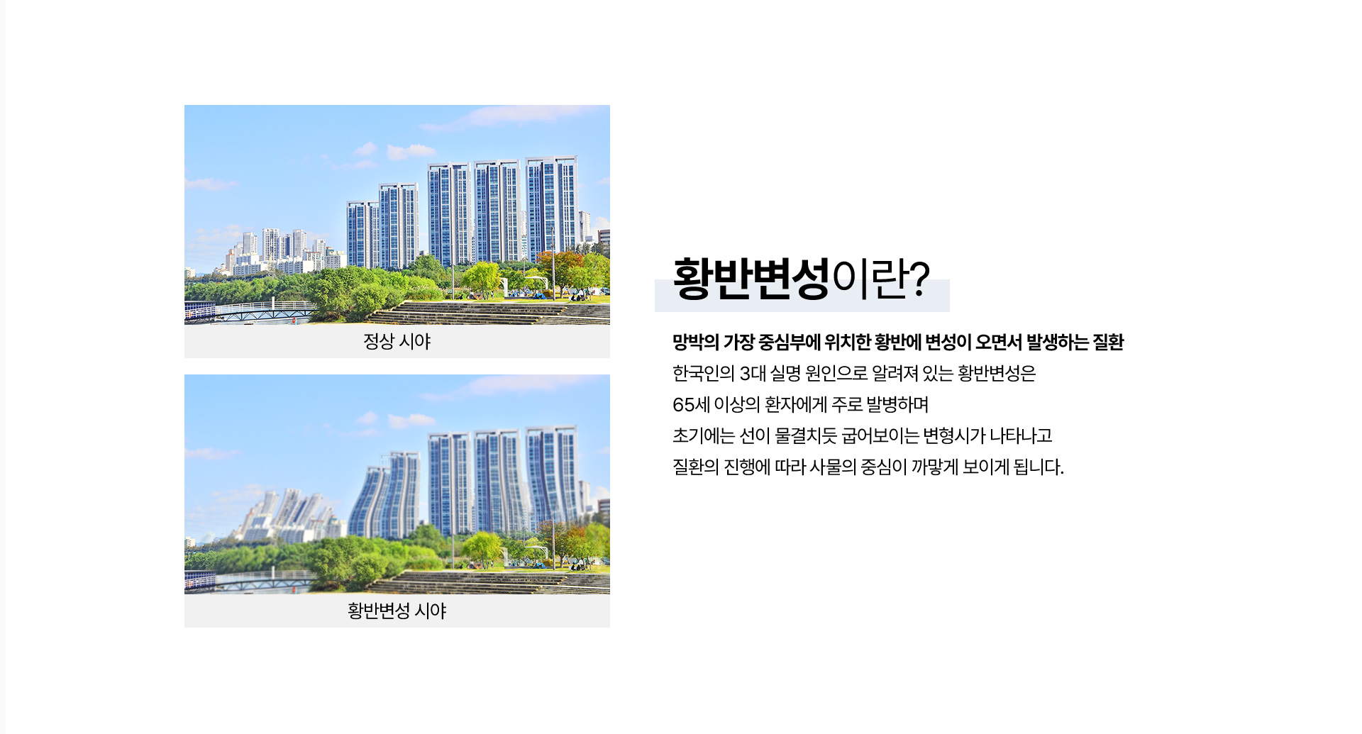 황반변성_01