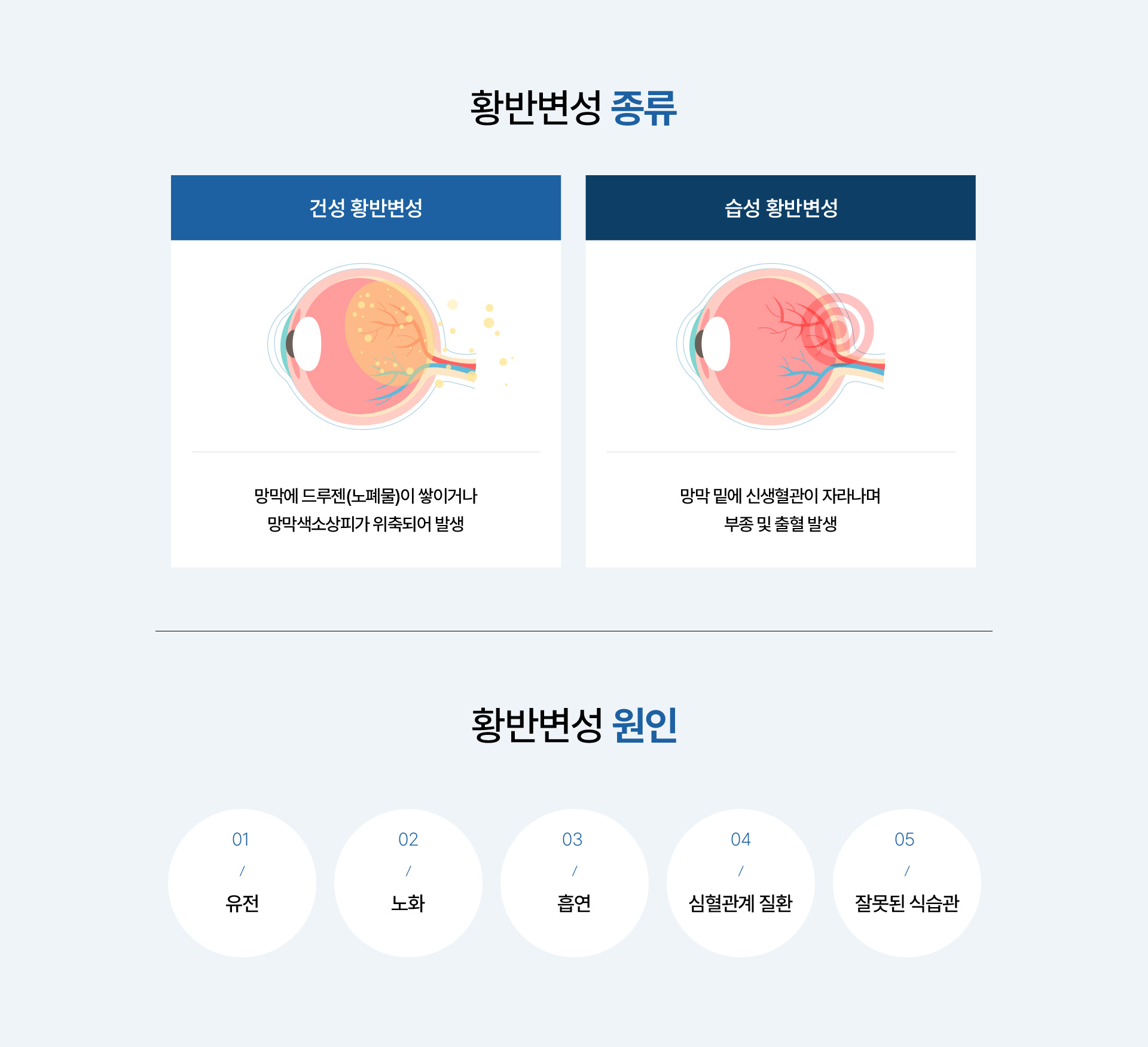황반변성_02
