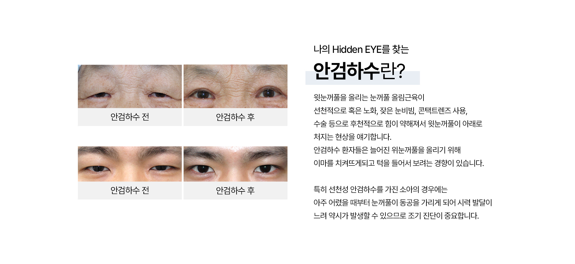 안검하수_05