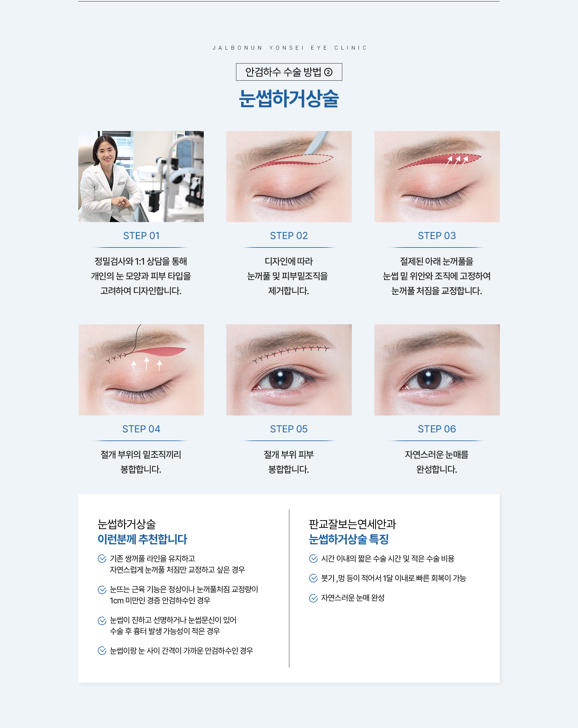 안검하수_10
