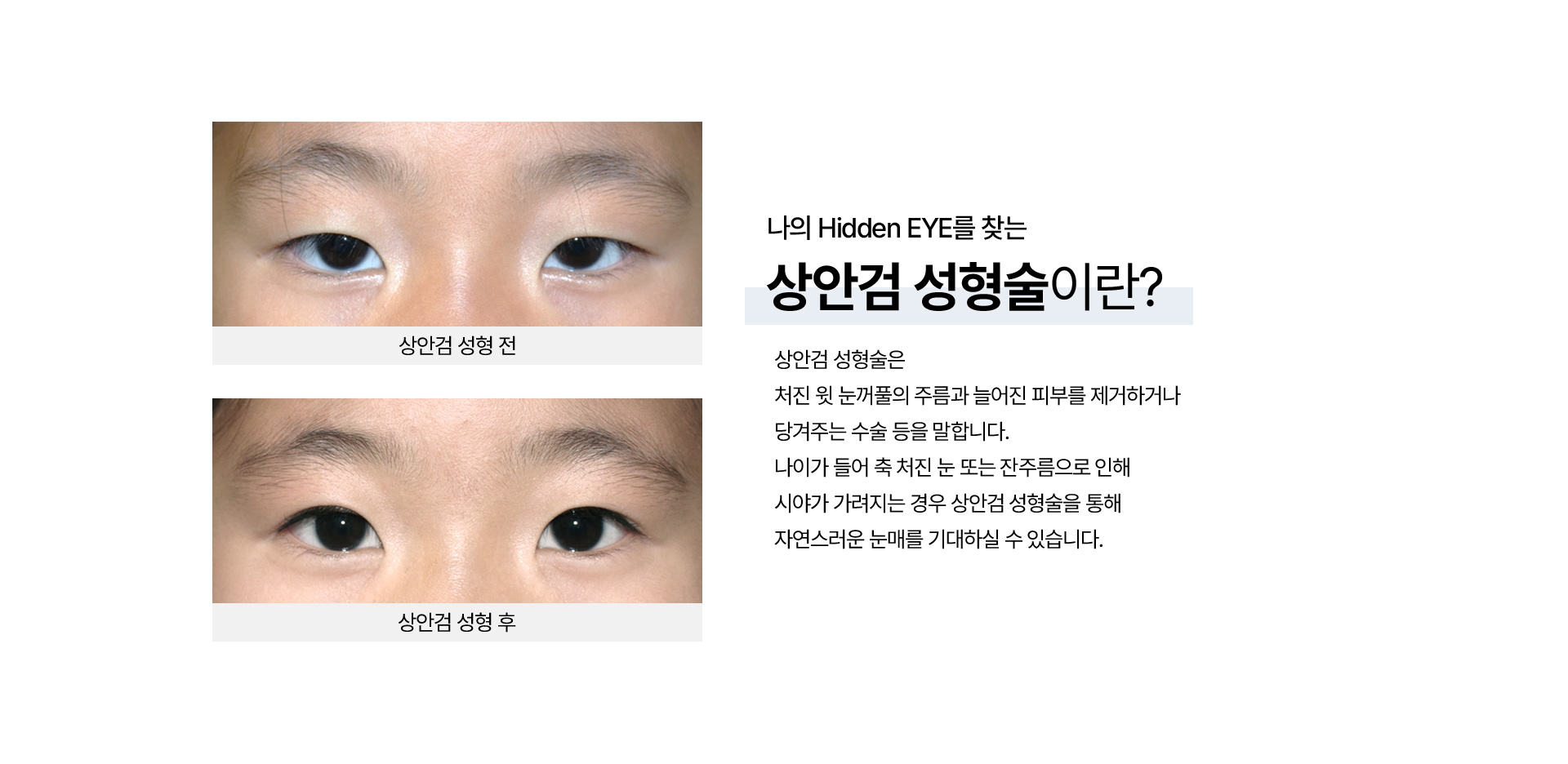 상안검 성형_05