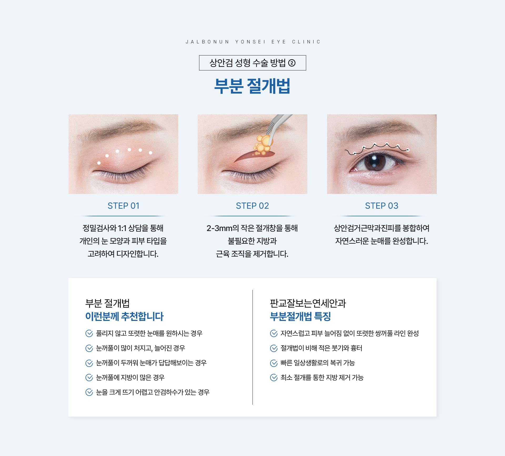 상안검 성형_08